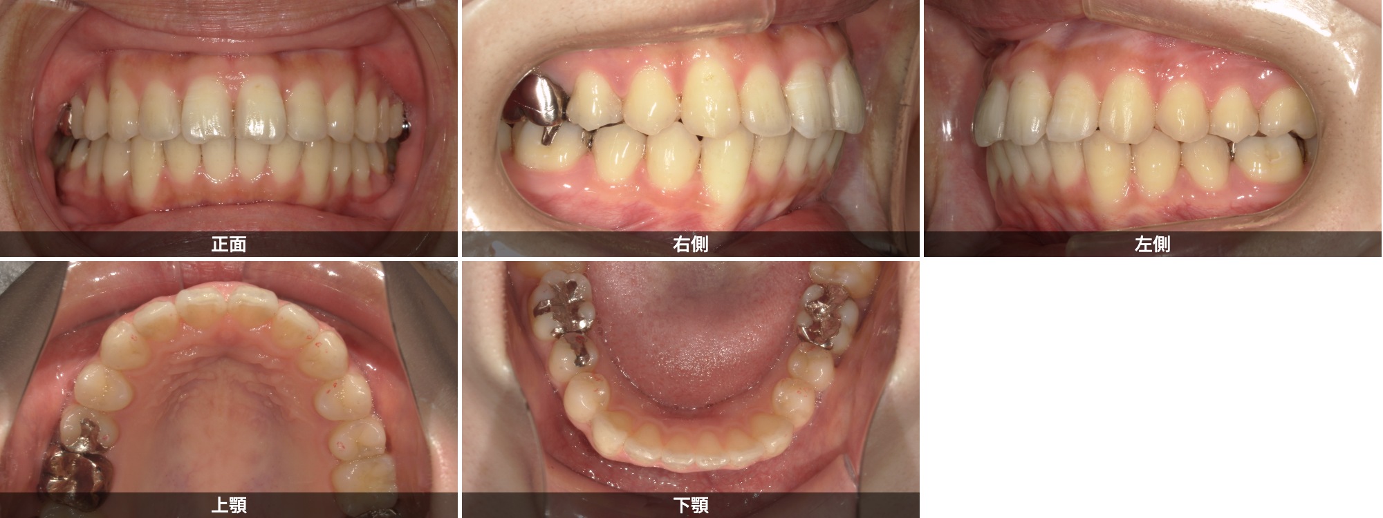 出っ歯(上顎前突)治療後 20代女性