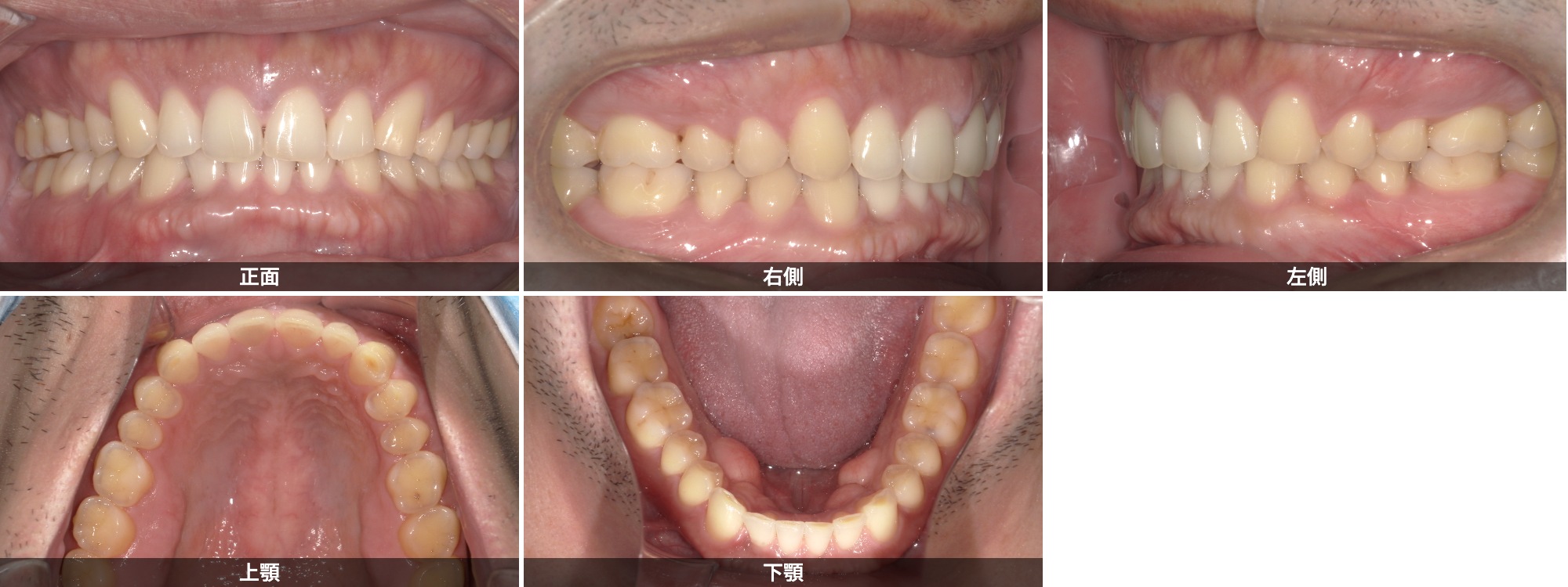 すきっ歯(空隙歯列)治療後 30代男性