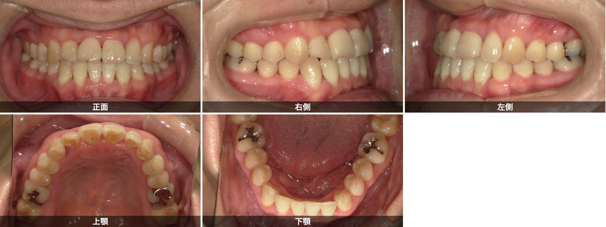 受け口(下顎前突)治療後 30代男性