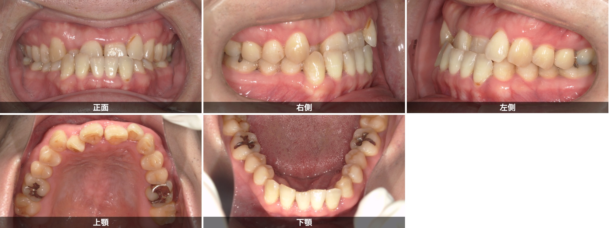 受け口(下顎前突)治療前 30代男性